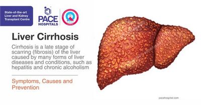 Understanding the Cause and Prevention of Cirrhosis